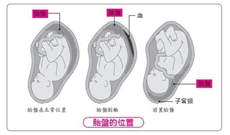 胎盤剝離方式|了解胎盤早期剝離